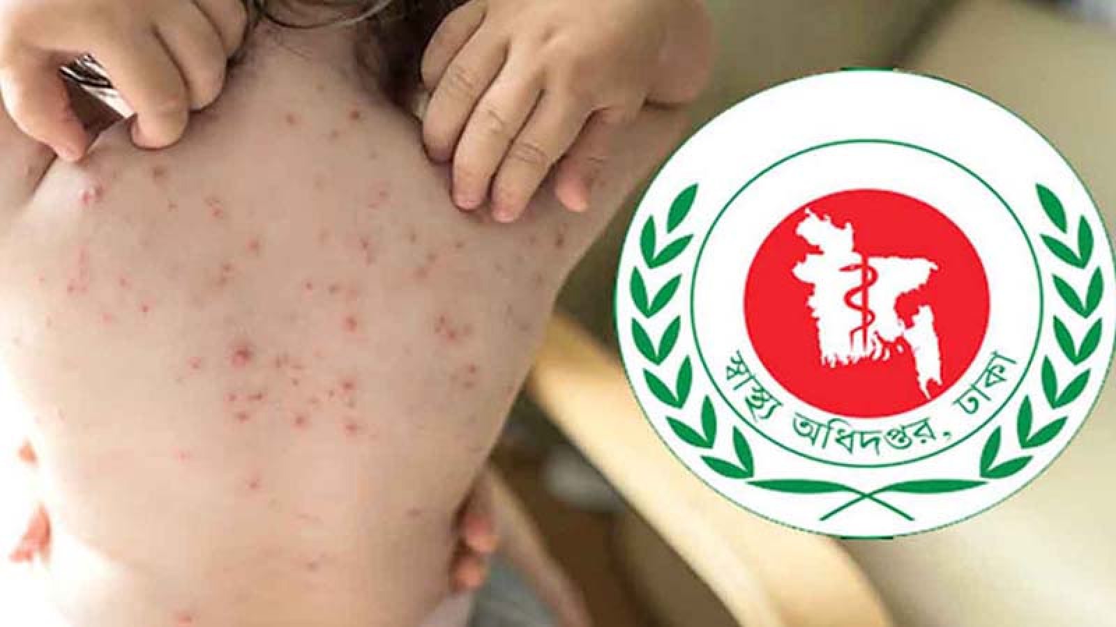 হাম ও হামের উপসর্গে আরও ১১ শিশুর মৃত্যু