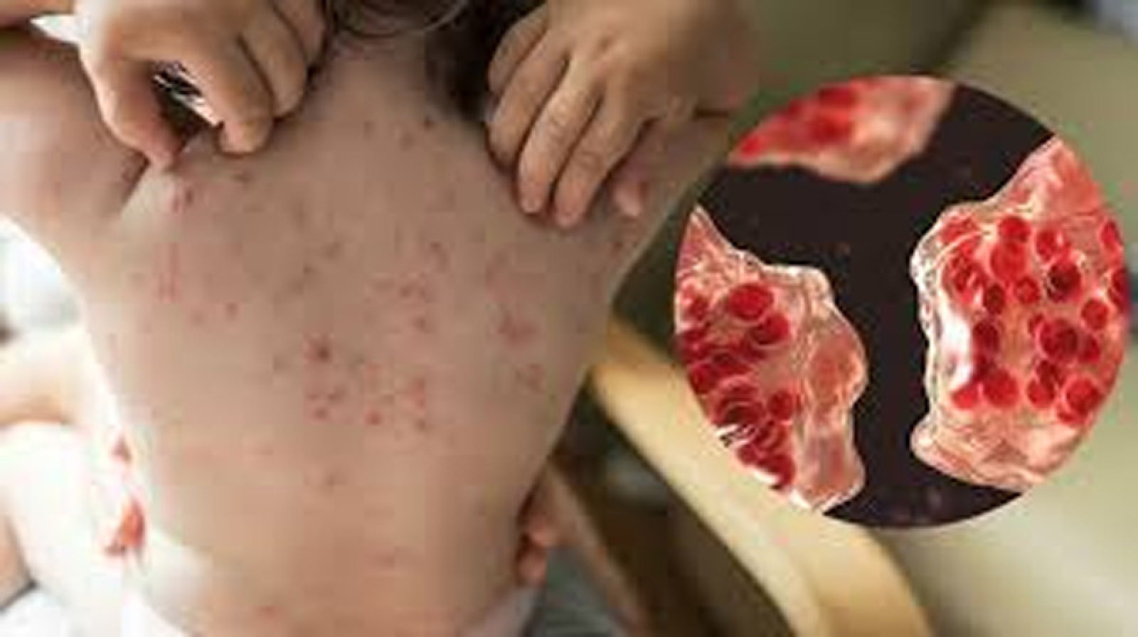 প্রায় নির্মূল হওয়া হাম আবার দেশে দেশে ফিরছে কেন