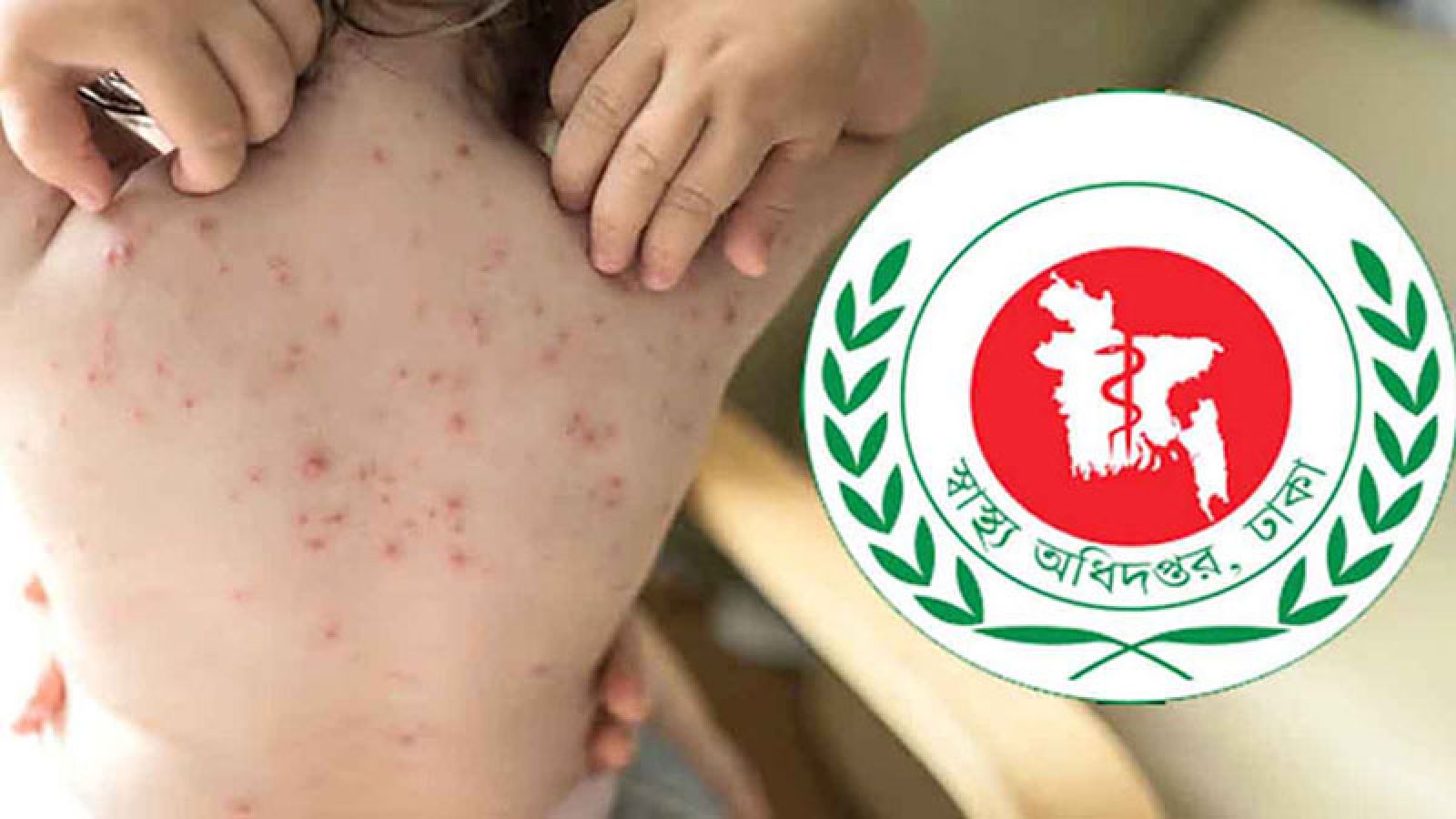 দেশে হামের উপসর্গ নিয়ে আরও ৭ শিশুর মৃত্যু, আক্রান্ত ১৫১৮
