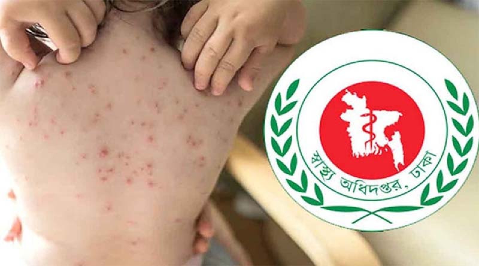 হাম ও হামের উপসর্গ নিয়ে দেশে মৃত্যু ছাড়ালো ১১০০