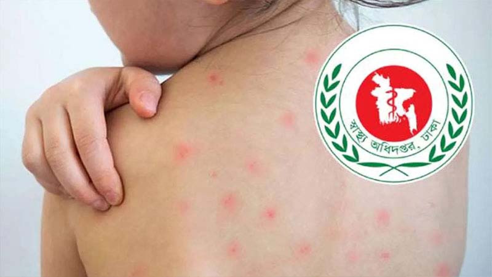 হাম সন্দেহে আরও ছয়জনের মৃত্যু