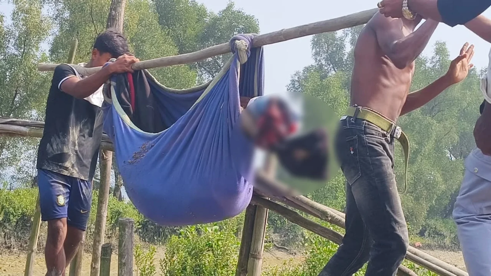 আরাকান আর্মির পুঁতে রাখা মাইন বিস্ফোরণে যুবকের পা বিচ্ছিন্ন