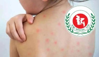 হামের উপসর্গ নিয়ে আরও ৭ মৃত্যু